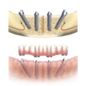 Chirurgie orale Limoges all on 4