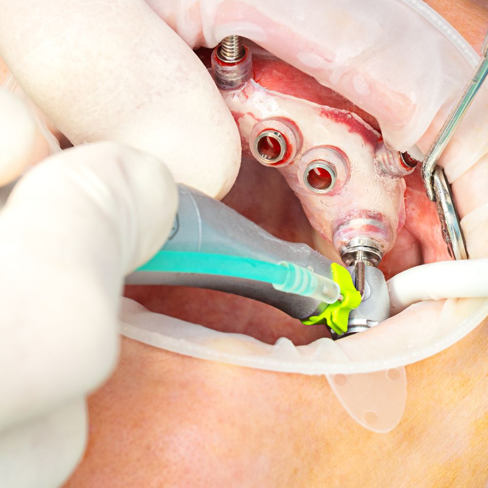Chirurgie orale Limoges chirurgie implantaire guidee