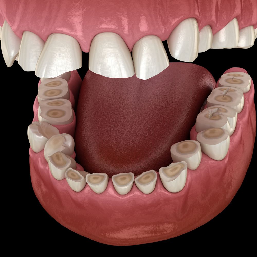 Chirurgie orale Limoges dents delabrees