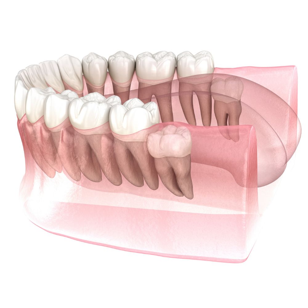 Chirurgie orale Limoges dents de sagesse
