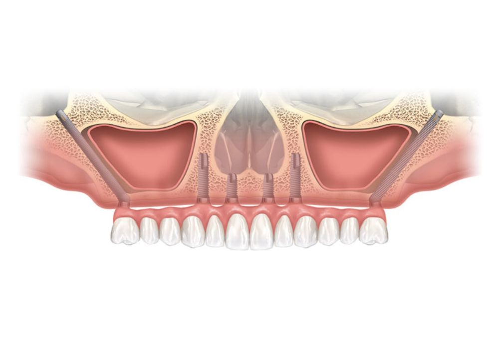 Chirurgie orale Limoges implant zygomatique