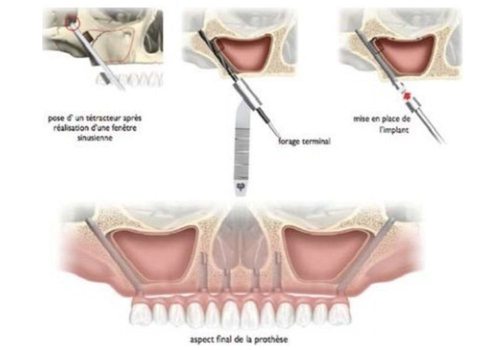Chirurgie orale Limoges implant zygomatique