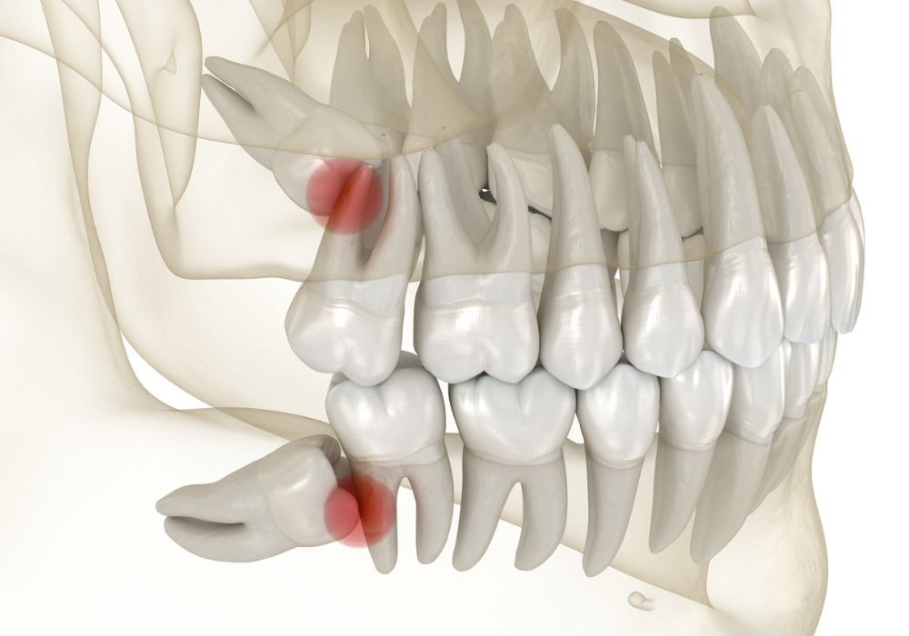 Chirurgie orale Limoges dents de sagesse