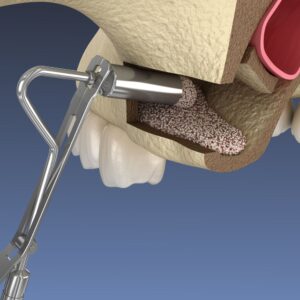 Chirurgie orale Limoges sinus lift
